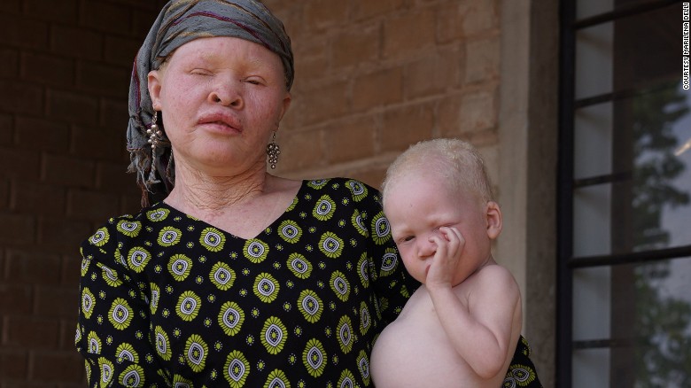 В Африке альбиносов приравнивают к домашним питомцам.Вокруг Света. Украина