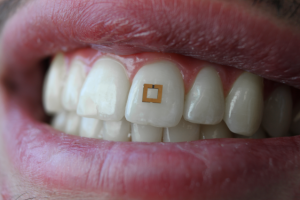 На один зуб: изобрели сенсор, способный следить за диетой